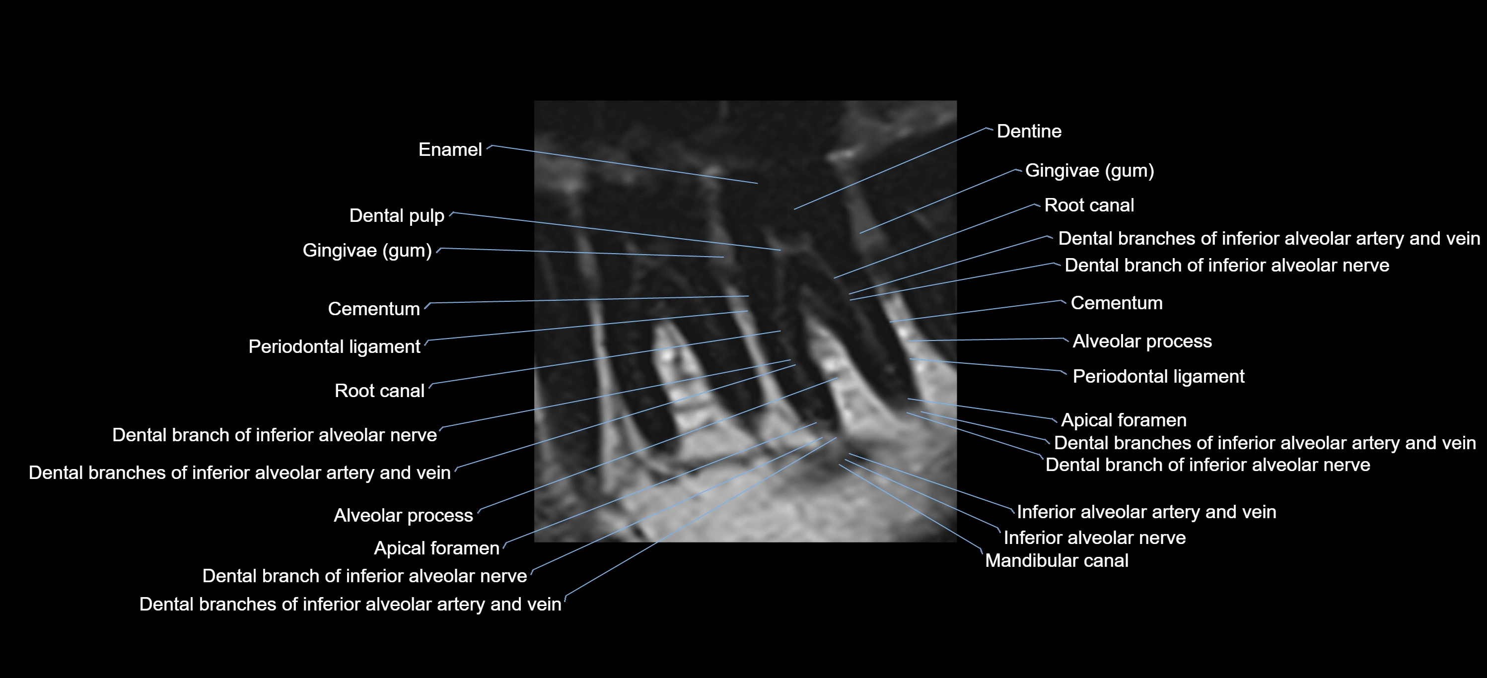 MRI tooth sagittal micro cross sectional 3T labelled anatomy image-00003.webp